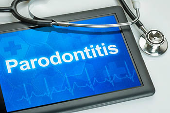 Gefahr Parodontitis